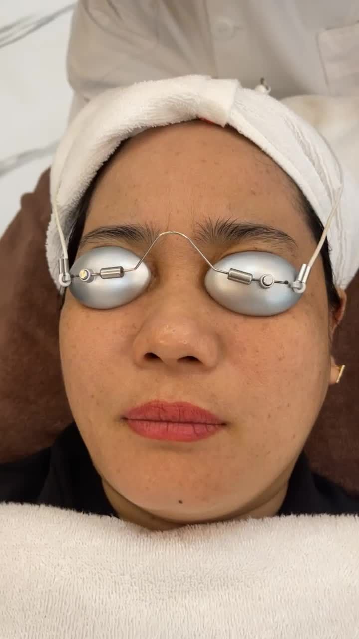 ĐIỀU TRỊ TÀN NHANG BẰNG LASER PICOSURE HIỆU QUẢ 99%
